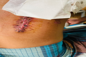 Ein Mann im Krankenhausbett mit einem verbundenen Bein und einer Narbe auf dem Bauch, mit einer anderen Person und einem Tisch im Hintergrund.